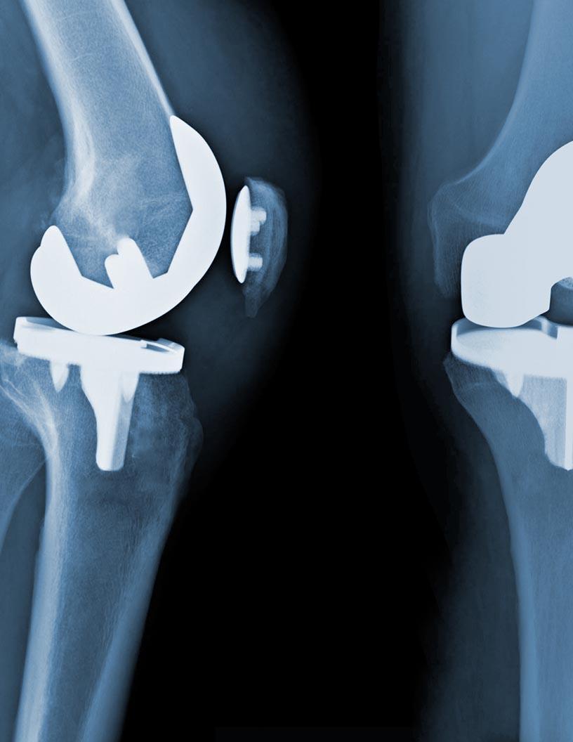 Digit Joint Implants Market Analysis, Size, and Forecast 2025-2029: North America (US, Canada, and Mexico), Europe (France, Germany, and UK), APAC (China and Japan), South America (Argentina and Brazil), and Rest of World (ROW)
