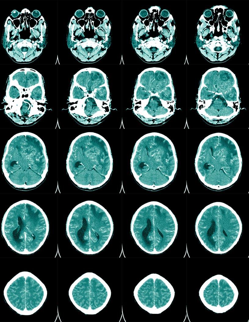 Non-Invasive Intracranial Pressure Monitoring Devices Market Analysis North America, Europe, Asia, Rest of World (ROW) - US, UK, Germany, China, Japan, Canada, Mexico, France, India, Brazil - Size and Forecast 2025-2029