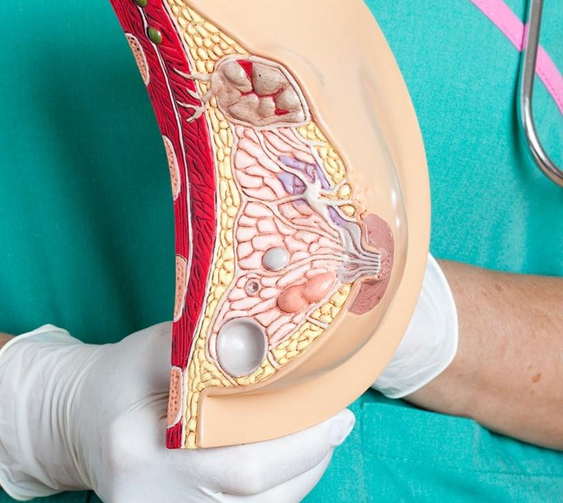 Breast Tissue Expander Market Analysis, Size, and Forecast 2025-2029: North America (US and Canada), Europe (France, Germany, Italy, and UK), APAC (China, India, and Japan), South America (Brazil), and Rest of World (ROW)