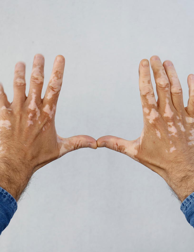 Vitiligo Therapeutics Market Analysis Growth, Trends and Regional Forecast 2024-2028