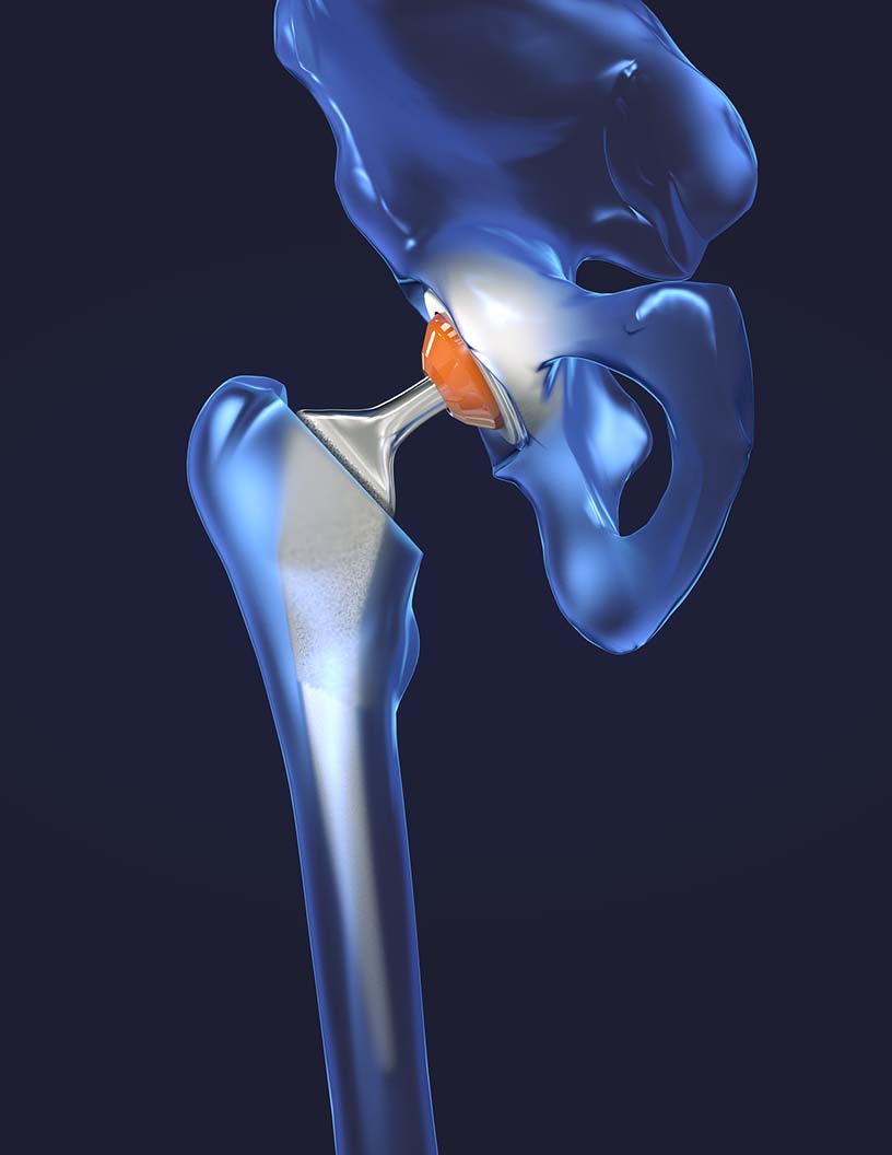 Bone Replacement Market Analysis North America, Europe, Asia, Rest of World (ROW) - US, Germany, UK, China, Japan - Size and Forecast 2024-2028