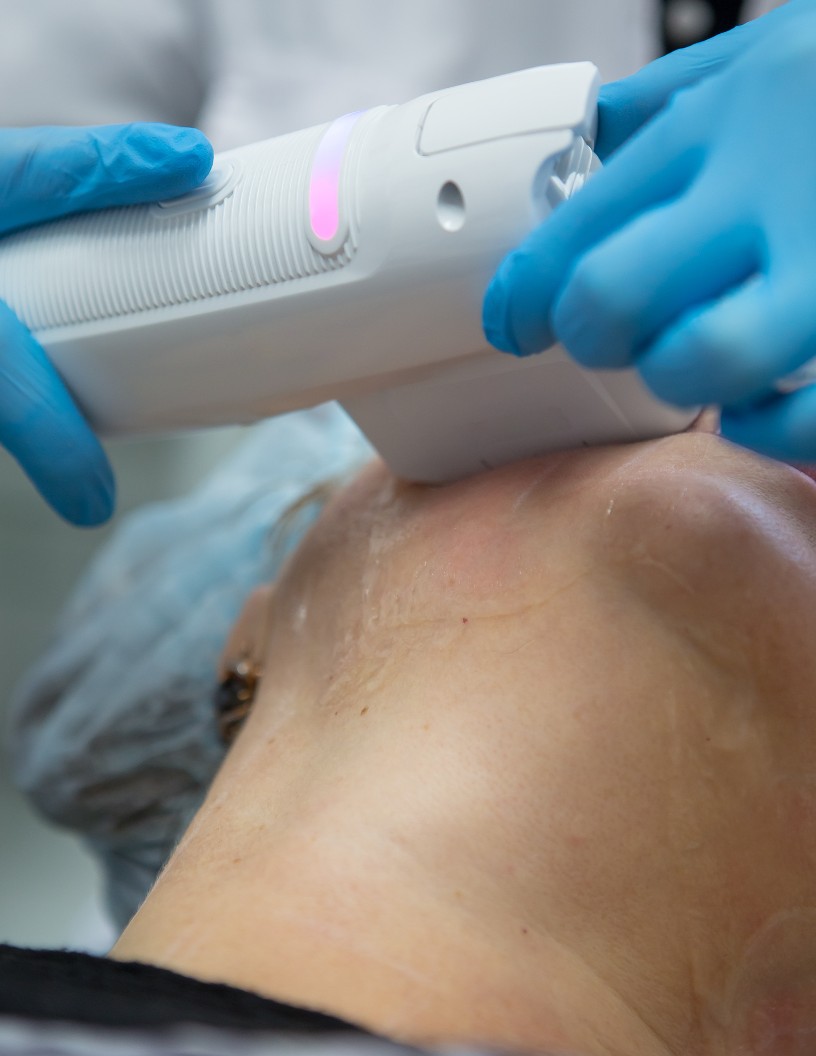 Non-Surgical Skin Tightening Market Analysis North America, Europe, APAC, South America, Middle East and Africa - US, China, Canada, Germany, UK - Size and Forecast 2024-2028