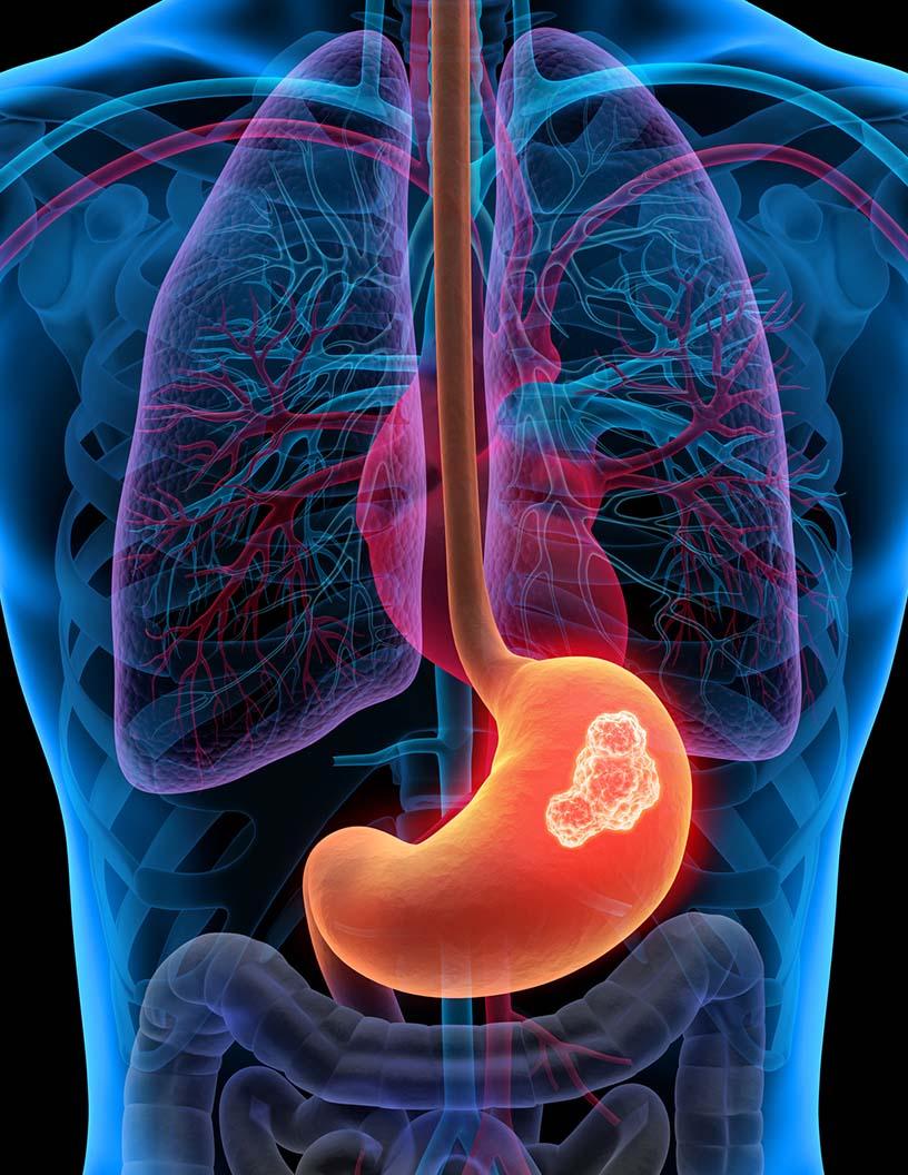 Gastric Cancer Drugs Market Analysis, Size, and Forecast 2025-2029: North America (US and Canada), Europe (France, Germany, Italy, and UK), Middle East and Africa (Egypt, KSA, Oman, and UAE), APAC (China, India, and Japan), South America (Argentina and Brazil), and Rest of World (ROW)
