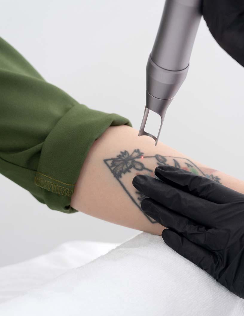 Tattoo Removal Market Analysis, Size, and Forecast 2025-2029: North America (US and Canada), Europe (France, Germany, Italy, and UK), APAC (China, India, Japan, and South Korea), and Rest of World (ROW)