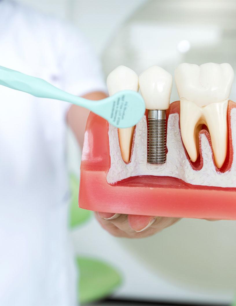 China Dental Implants Market Analysis, Size, and Forecast 2025-2029