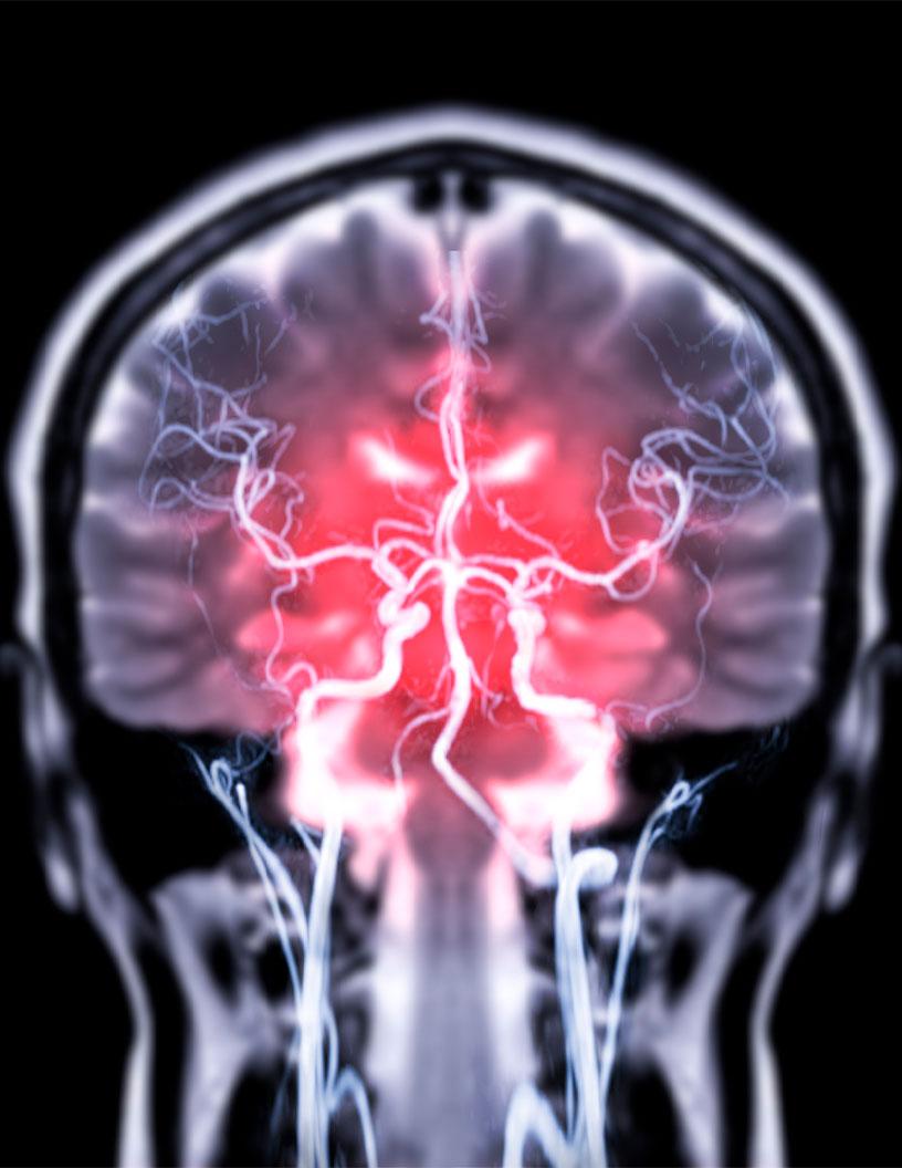Neuroendovascular Non-Coils Market Analysis, Size, and Forecast 2025-2029: North America (US and Canada), Europe (France, Germany, and UK), APAC (China, India, Japan, and South Korea), South America (Brazil), and Rest of World (ROW)