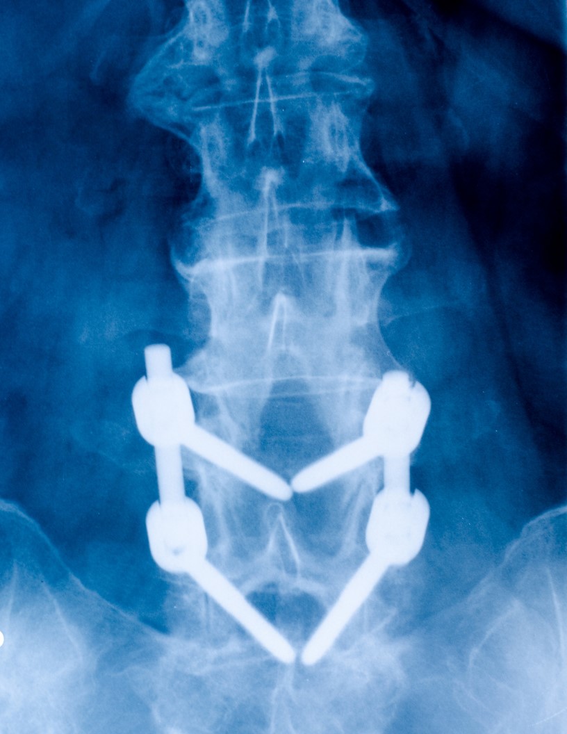 Osteosynthesis Devices Market Analysis North America, Europe, Asia, Rest of World (ROW) - US, Canada, Germany, UK, China - Size and Forecast 2024-2028