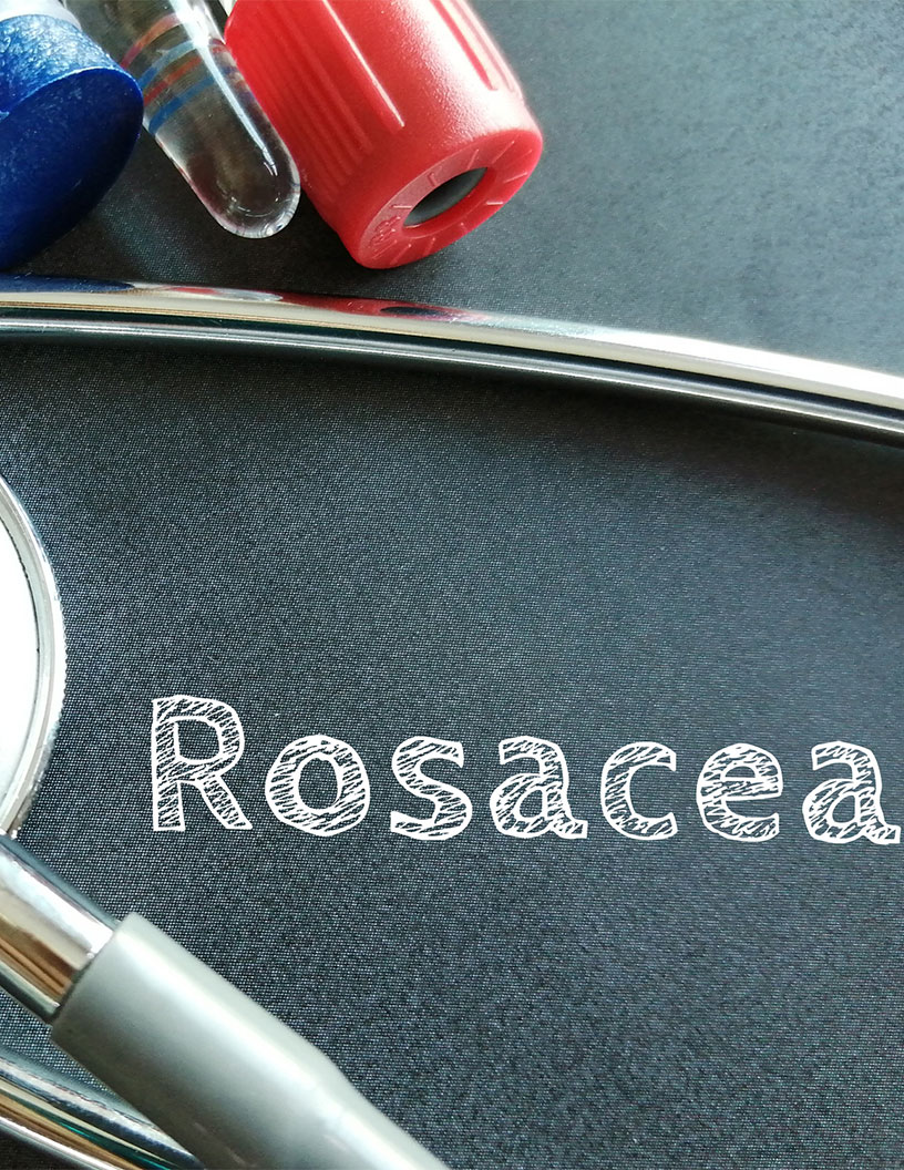 Rosacea Treatment Market Analysis North America, Europe, Asia, Rest of World (ROW) - US, Germany, UK, Russia, China - Size and Forecast 2024-2028