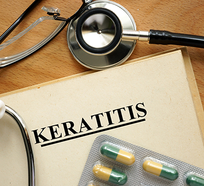 Keratitis - A Pipeline Analysis Report