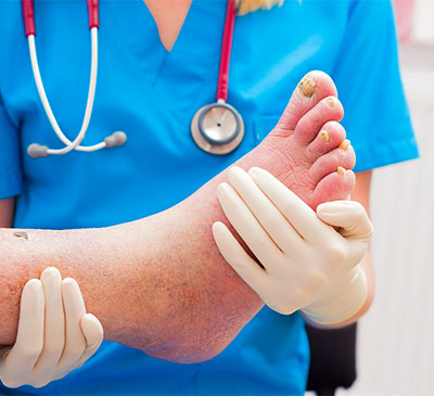 Onychomycosis - A Pipeline Analysis Report