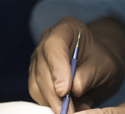 Global Ophthalmic Knives Market 2019-2023