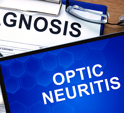 Optic Neuritis - A Pipeline Analysis Report