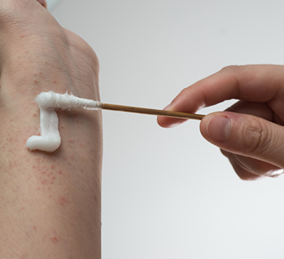 Pemphigus Vulgaris - A Pipeline Analysis Report