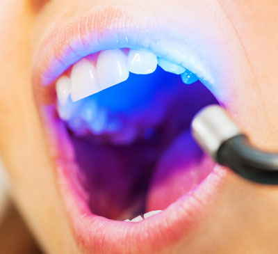 Dental Lasers Market by Product, End-user, and Geography - Forecast and Analysis 2021-2025