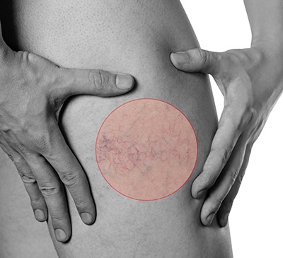 Venous Leg Ulcer - A Pipeline Analysis Report